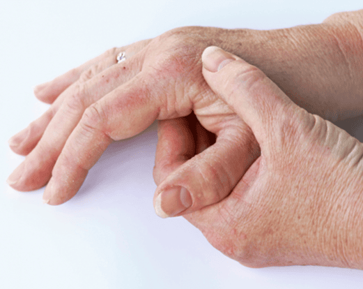 Connective Tissue Disease Connective Tissue Disease