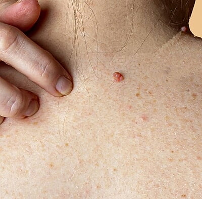 Benign and Precancerous Lesions