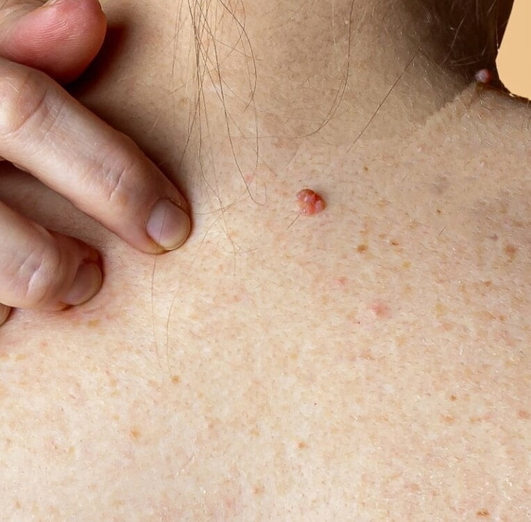 Benign and Precancerous Lesions Benign and Precancerous Lesions