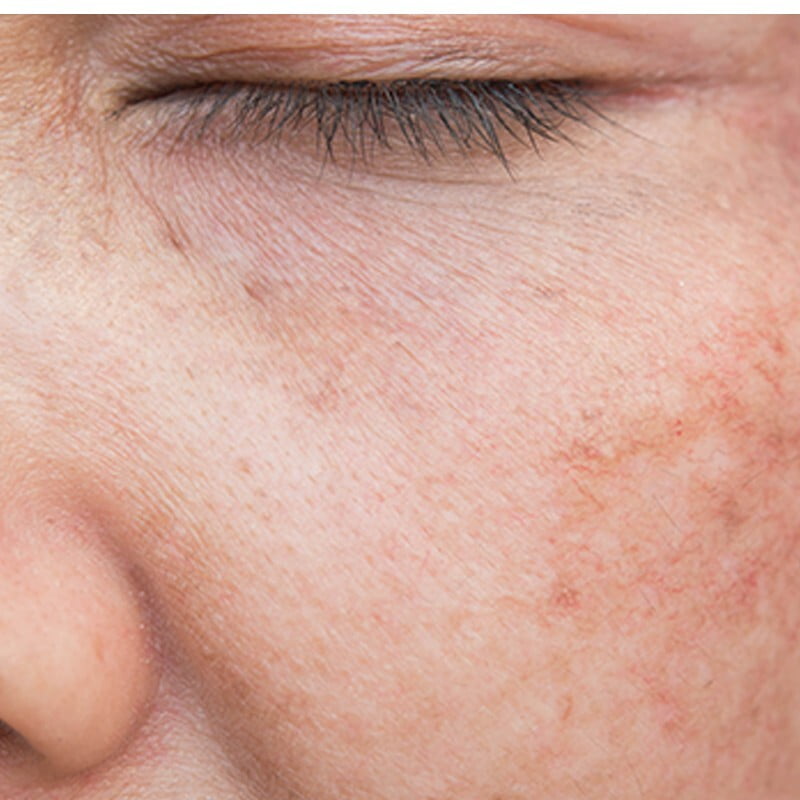 Light Related Skin Disease and Pigmentation Disorders Light Related Skin Disease and Pigmentation Disorders