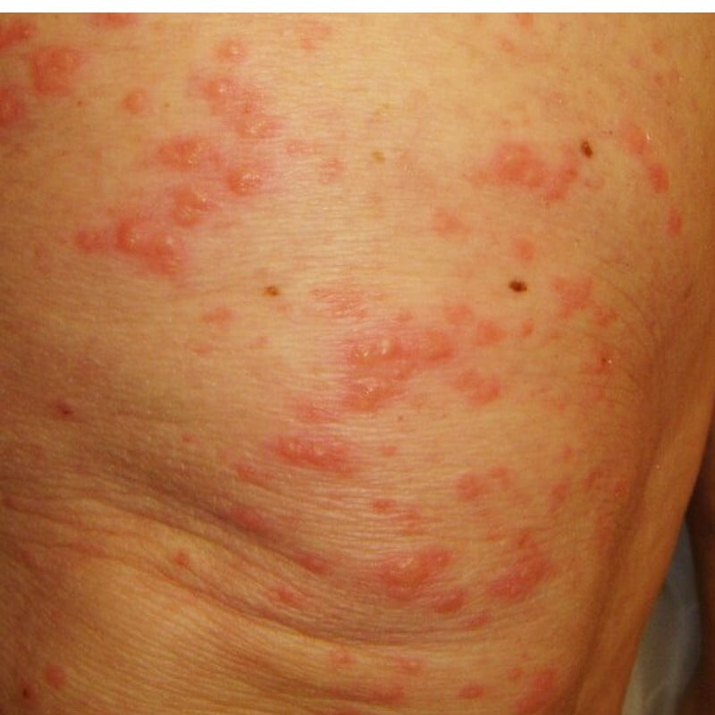 Vesicular and Bullous Disease Vesicular and Bullous Disease
